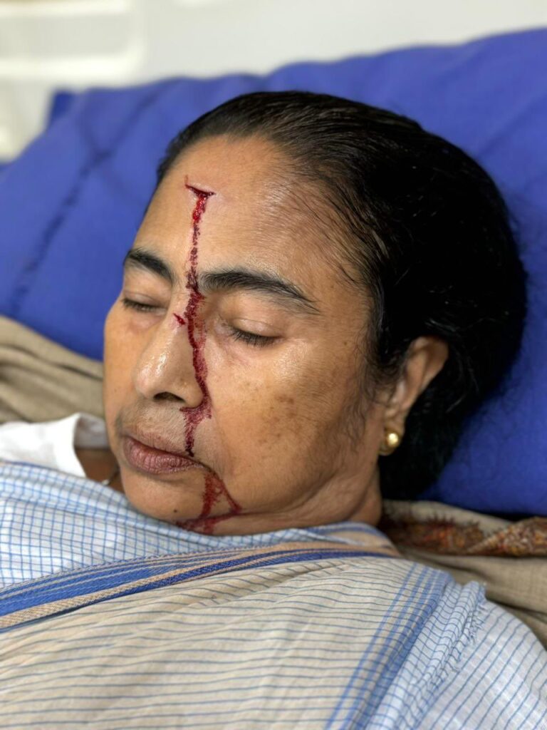ममता बनर्जी- Big News: बंगाल की सीएम ममता बनर्जी चोटिल, सिर पर लगी गंभीर चोट, अस्पताल में किया गया भर्ती।
