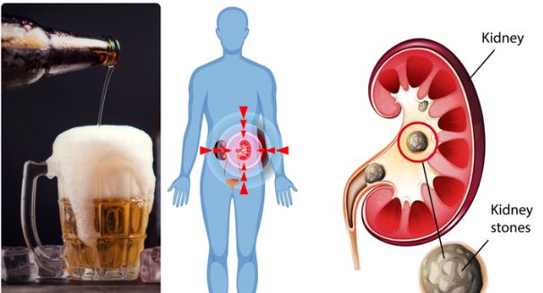 क्या बीयर पीने से सच में किडनी स्टोन निकल जाता है? डॉक्टर से जानिए इसकी सच्चाई