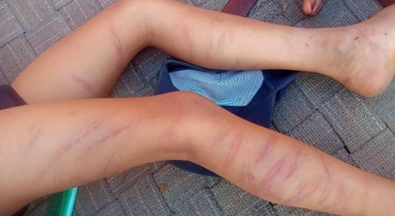 टीचर बना बेरहम-  कक्षा दो के छात्र को गिनकर मारे 105 डंडे, पैरों और शरीर पर गहरे चोट के निशान, देखकर कांप गए घरवाले