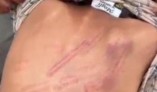 मासूम के सवाल पर मैडम भड़की- पहली कक्षा के बच्चे को डंडे से पीटा, पीठ पर पड़े निशान,हायर सेंटर रेफर