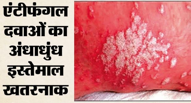 फंगल इंफेक्शन- हर साल 30 करोड़ लोग हो रहे फंगल संक्रमण का शिकार, WHOने जारी की वैश्विक रणनीति